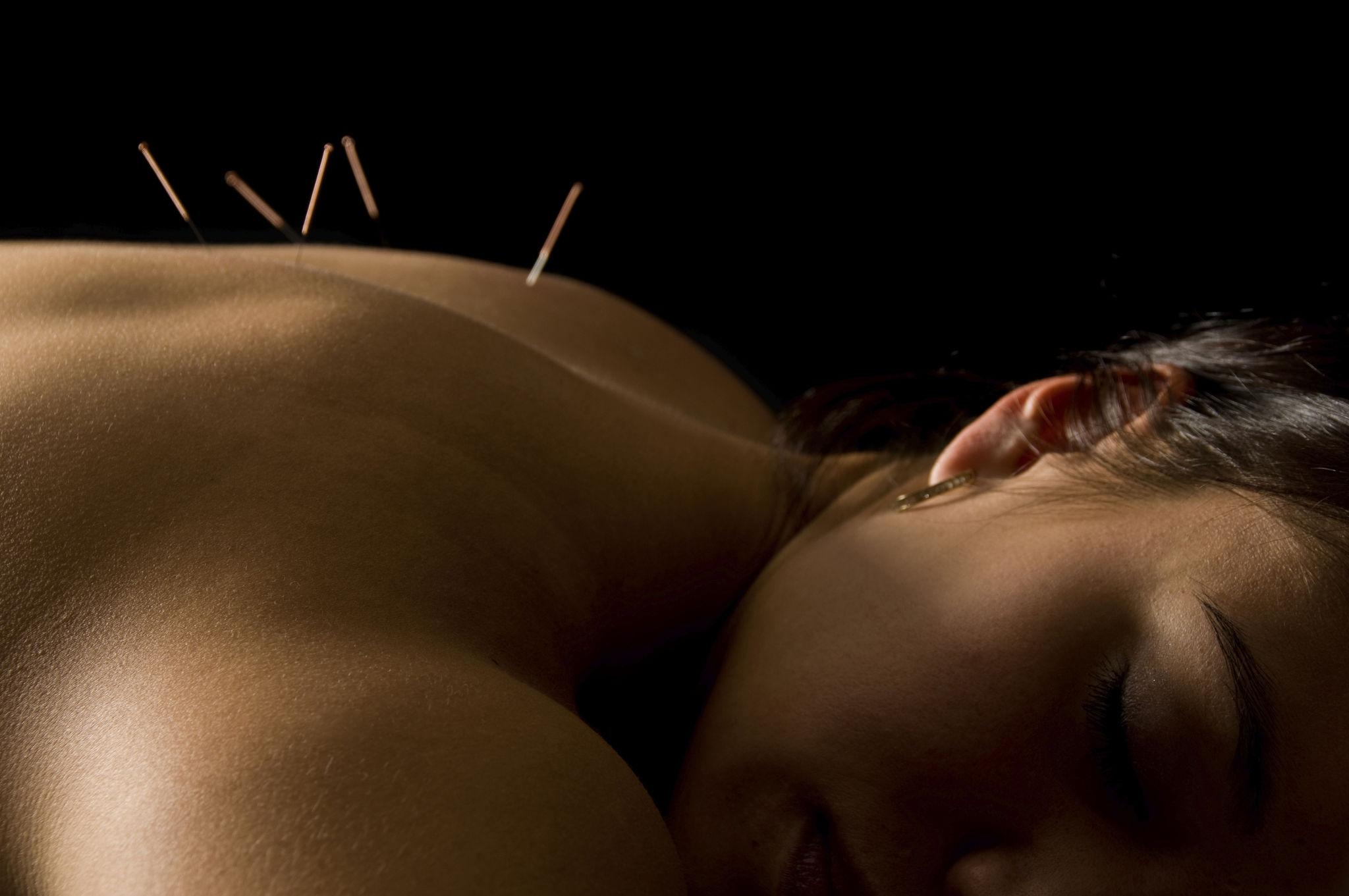 Benefits of Acupuncture