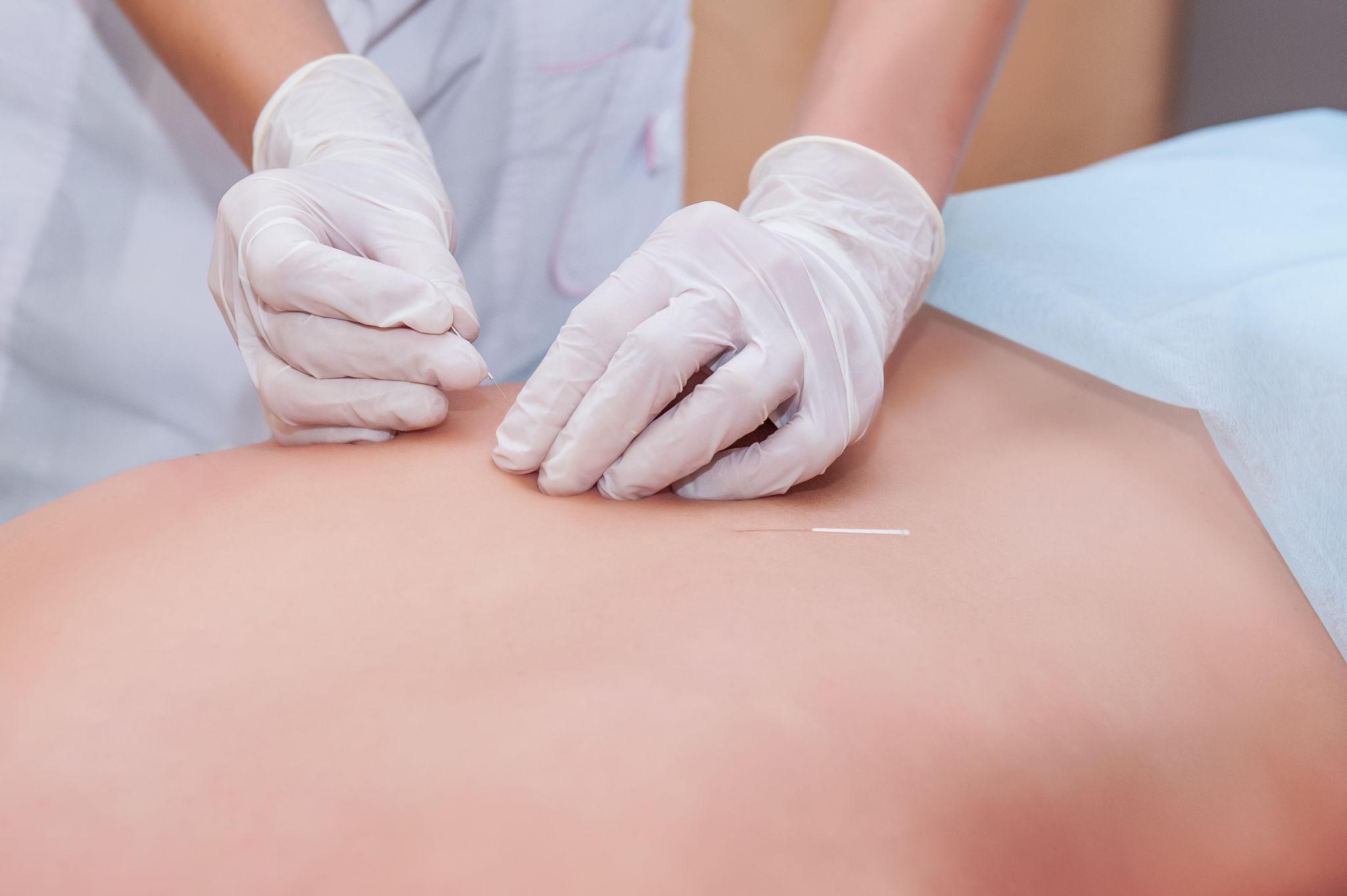 Is Acupuncture Safe?